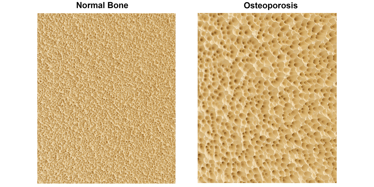 infographic depicting an image of bne with normal density vs. an image of bone density of someone with osteoperosis
